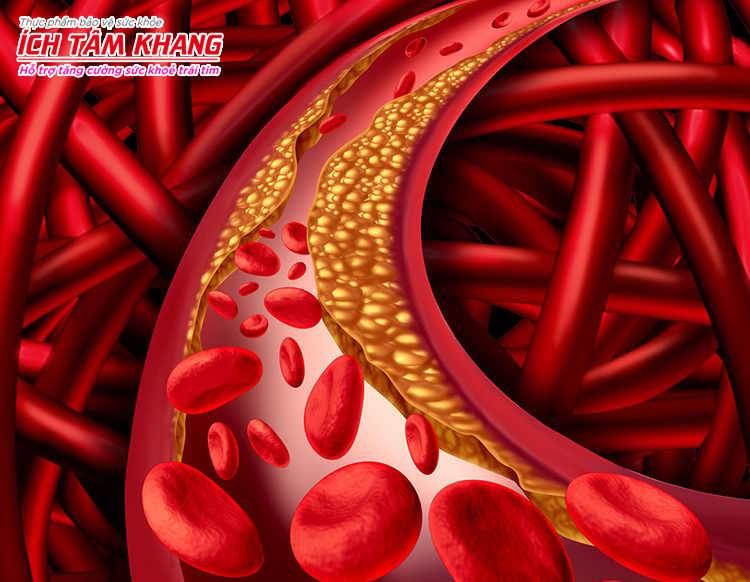 Cholesterol là nguyên liệu hình thành mảng xơ vữa - nguyên nhân chính gây hẹp mạch vành